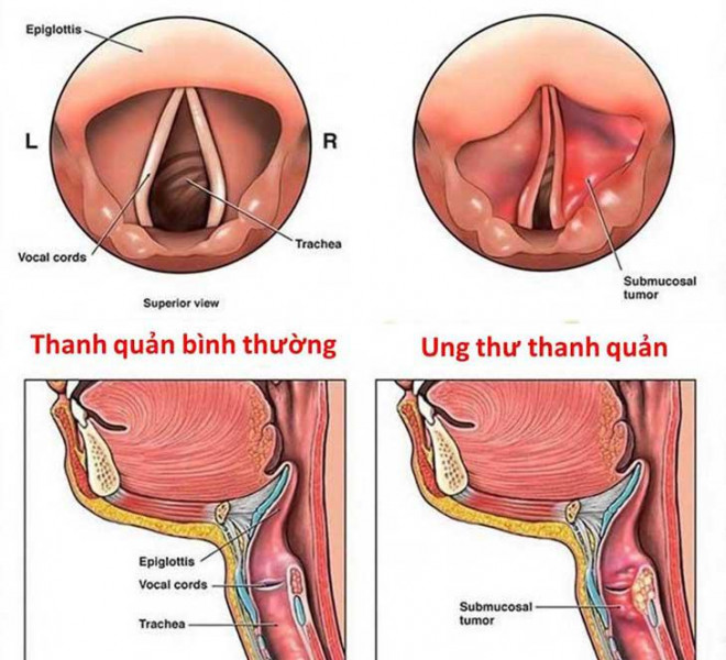 Ung thư thanh quản: Dấu hiệu, nguyên nhân, điều trị và tiên lượng - 2