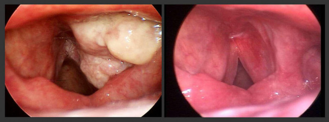 Ung thư thanh quản: Dấu hiệu, nguyên nhân, điều trị và tiên lượng - 4