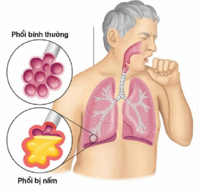 Chăm sóc phổi đúng cách trong mùa dịch COVID-19 - 5