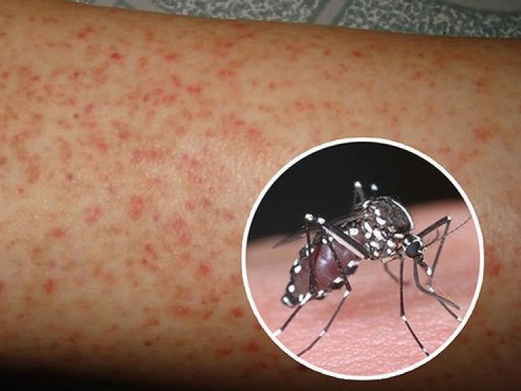 Sức khỏe đời sống - Hà Nội có 178 ổ dịch sốt xuất huyết đang hoành hành