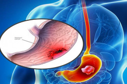 Sức khỏe đời sống - Ung thư dạ dày có biểu hiện rất mơ hồ, trường hợp nào nên đi khám ngay?