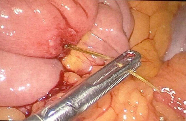 Xương cá là dị vật đường tiêu hóa thường gặp nhưng rất nguy hiểm cho người bệnh