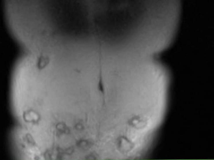 Sức khỏe đời sống - Vợ giấu chồng đi tiêm tan mỡ, sau 1 tháng bị hoại tử bụng