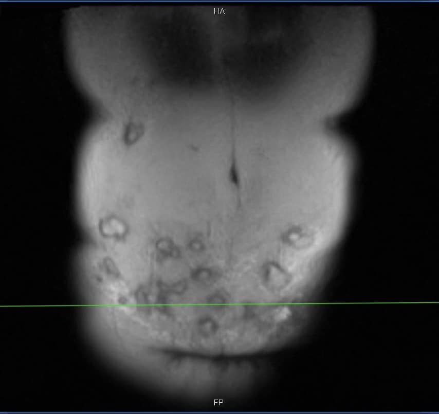Ổ áp xe trên ổ bụng.