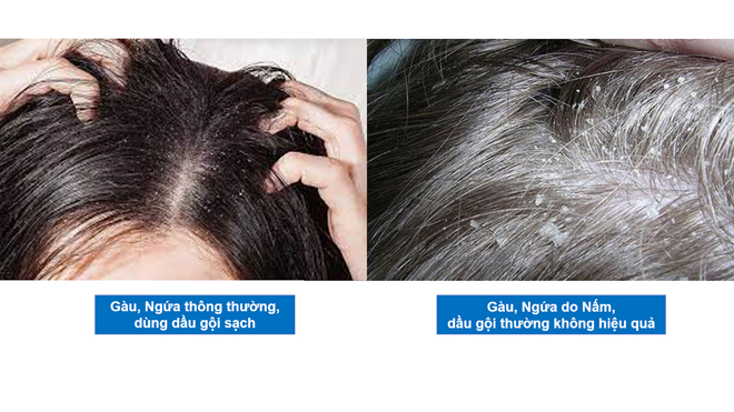 Gàu, nấm, ngứa "điên đầu" nên dùng dầu gội gì? - 1