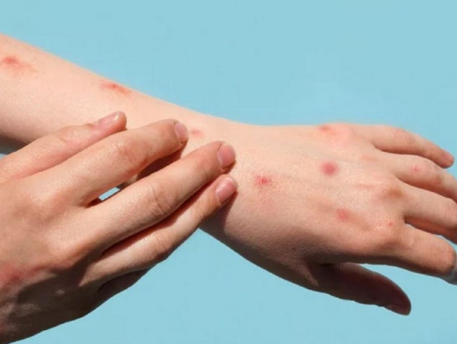 Các tổn thương da ở người mắc bệnh đậu mậu khỉ thường xuất hiện ở trên mặt, tay, chân và vùng sinh dục với biểu hiện là mụn nước hoặc sẩn hồng ban.