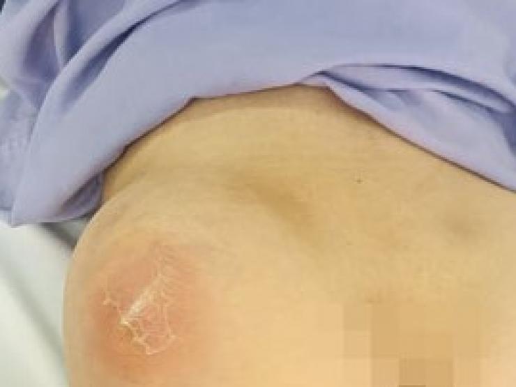 Sức khỏe đời sống - Tự tiêm thuốc bổ vào mông, người phụ nữ nhập viện