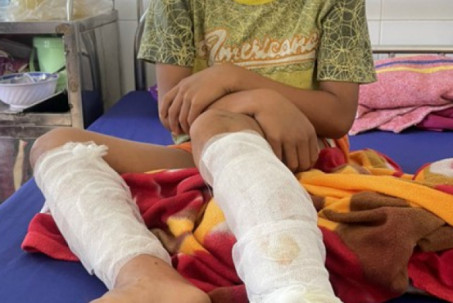 Một cháu bé 9 tuổi ở Quảng Bình bị người thân dùng xăng và rơm đốt