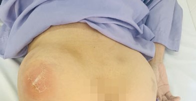 Vùng mông trái của người bệnh khi nhập viện đang áp xe, căng mủ.