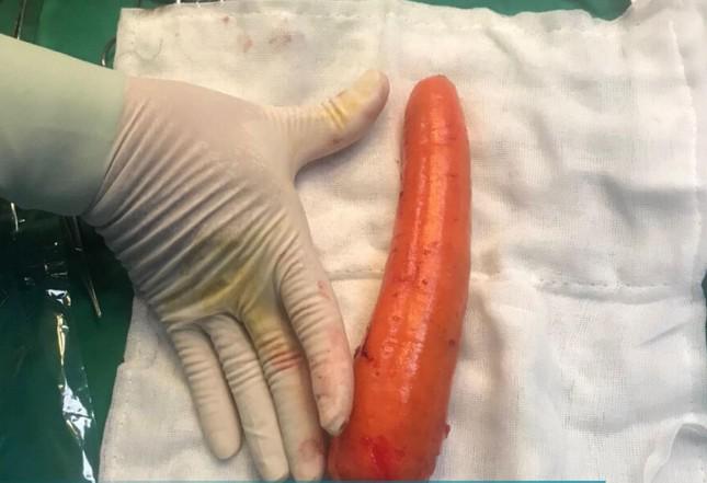 Củ cà rốt có đường kính lớn, dài hơn 20cm bệnh nhân tự nhét vào hậu môn