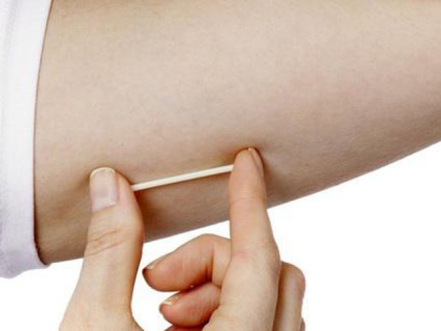 Sức khỏe đời sống - Từ trường hợp que tránh thai "đi lạc", chuyên gia giải thích về phương pháp cấy que tránh thai