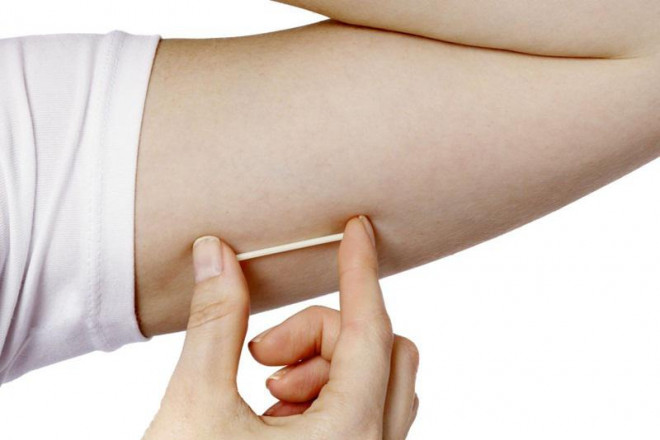 Que cấy tránh thai là một que nhỏ bằng đầu que diêm cấy vào cánh tay của bạn giúp giải phóng hormone progestin để ngăn việc mang thai.