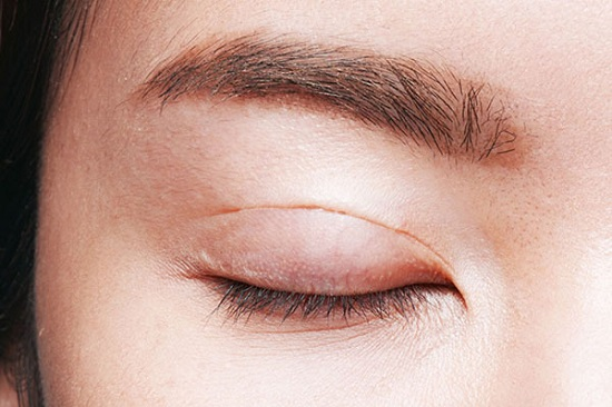 Việc sưng đau, tụ máu sau khi cắt mí là hiện tượng bình thường