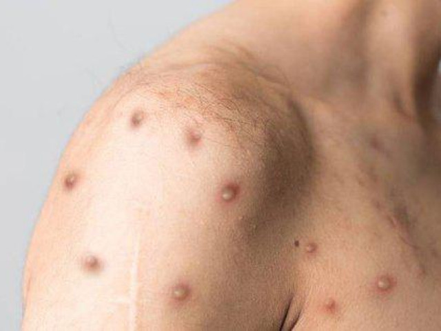 Sức khỏe đời sống - TP.HCM ghi nhận trường hợp mắc đậu mùa khỉ thứ hai