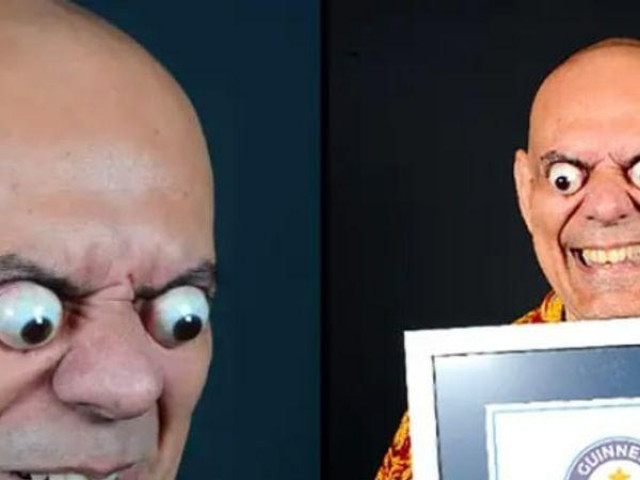 Phi thường - kỳ quặc - Giật mình nhìn nhãn cầu của người đàn ông lồi ra khỏi hốc mắt 1,8cm