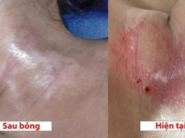 Sức khỏe đời sống - Bé gái 19 tháng tuổi bỏng nặng vì lọ dung dịch hầu hết "nhà nào cũng có"