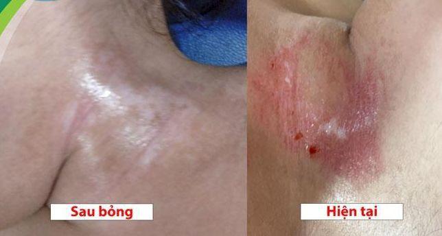 Sơ cứu bỏng hóa chất, 6 bước nhất định phải nhớ