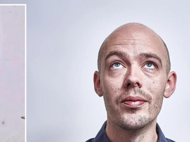 Sức khỏe đời sống - Đột phá khoa học trong việc chữa hói đầu