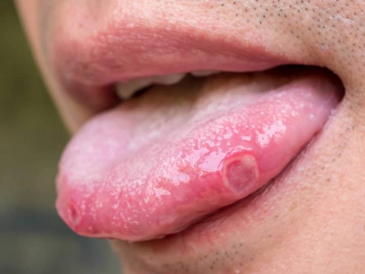 Sức khỏe đời sống - Vết loét ở lưỡi không lành trong vài tháng, người đàn ông sốc khi biết tin ung thư