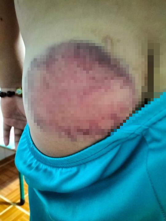 Hình ảnh vết bầm tím trên mông của cháu T. được gia đình đưa lên mạng