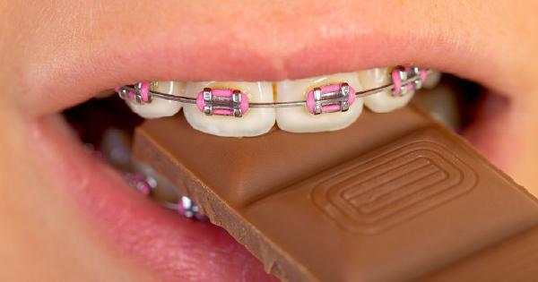 Thức ăn rất dễ mắc lại trên mắc cài, dây cung và hình thành mảng bám