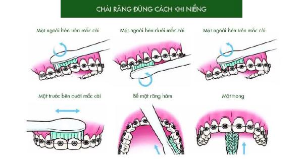 Các bước chải răng khi niềng răng