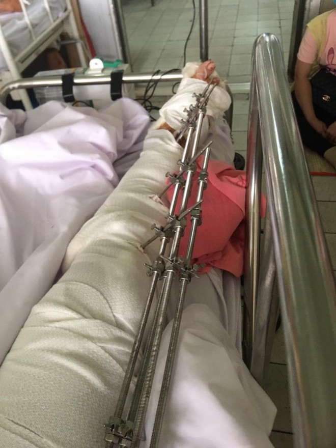 Vụ TNGT khiến bà H.T.M.H. - Quyền Trưởng phòng của TAND tỉnh Bến Tre bị thương tổn cơ thể 62%. Ảnh: NVCC