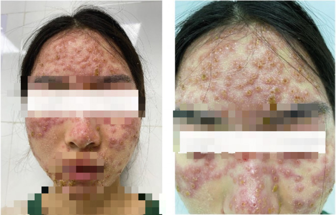 Hình ảnh mặt bệnh nhân bị bội nhiễm nghiêm trọng sau khi đắp mặt, bôi kem trị mụn tại spa. Ảnh BVCC