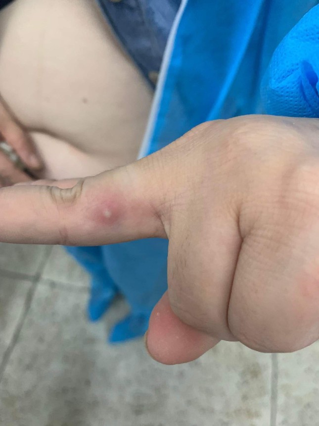 Bóng nước nổi trên ngón tay của bệnh nhân tại thời điểm nhập viện điều trị