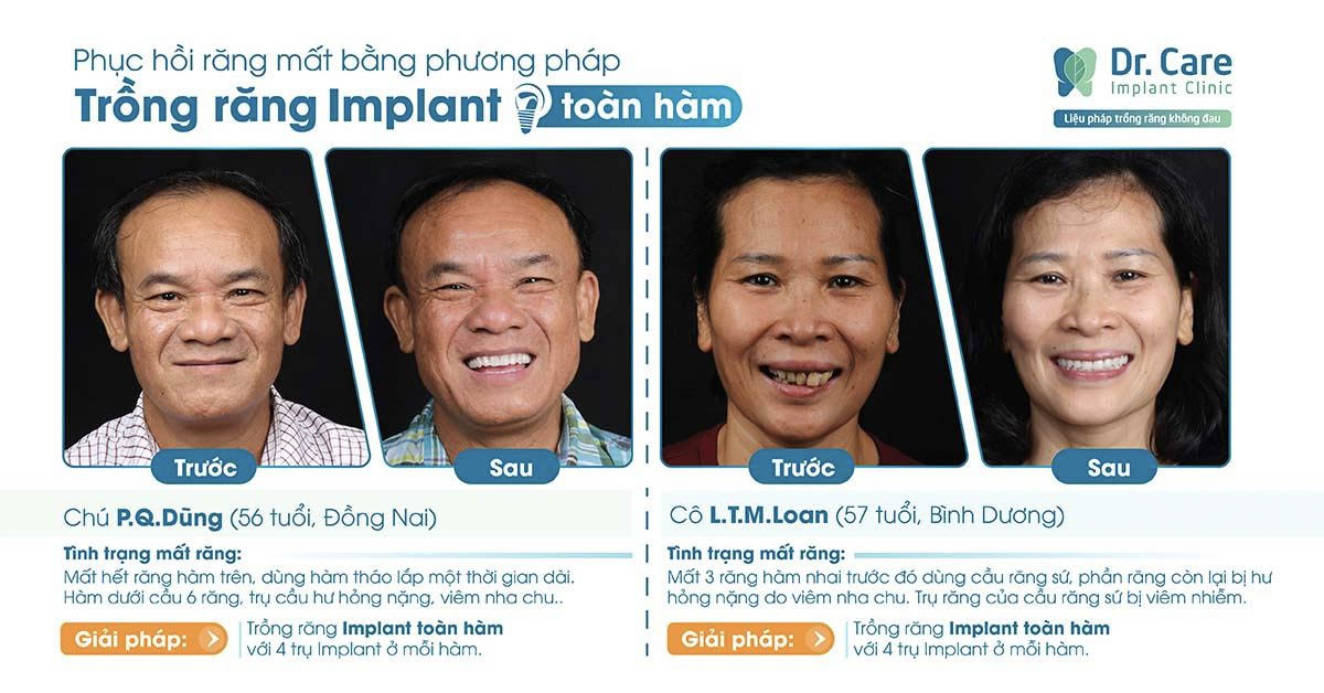 Giá trồng răng Implant tại nha khoa Dr. Care bao nhiêu tiền? - 2