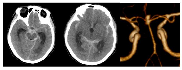 Hình ảnh chụp sọ não bệnh nhân phình mạch máu não thời điểm nhập viện.