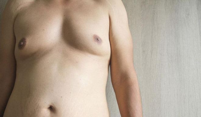 Mô vú phì đại là một trong những dấu hiệu của hội chứng Klinefelter ở nam giới.