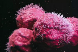 Sức khỏe đời sống - Người phụ nữ được chẩn đoán mắc 12 khối u có đột biến gien chưa từng thấy ở người