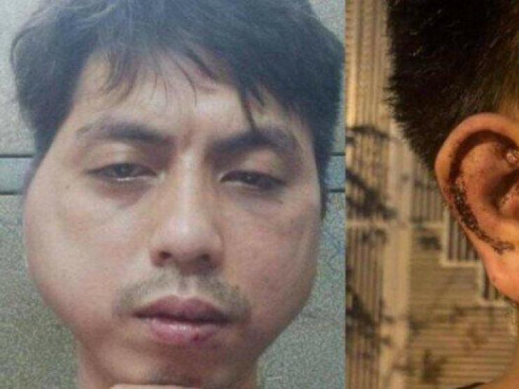 Pháp luật - Chủ quán lẩu đánh nhân viên biến dạng mặt, gãy xương sườn, xẹp phổi