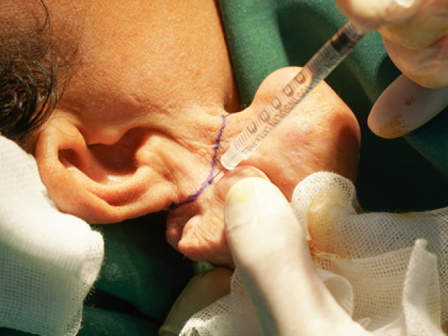 Sức khỏe đời sống - Nữ bệnh nhân bị dị dạng "tai voi" vì sai lầm nhiều người hay mắc phải