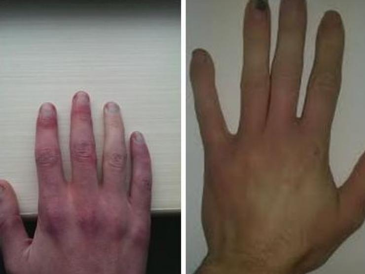 Sức khỏe đời sống - Người đàn ông 38 tuổi có bàn tay chuyển sang màu xanh, đỏ mỗi khi tức giận