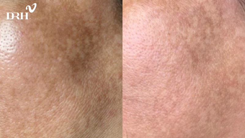 Bệnh nhân trị nám sau 01 liệu trình Mezoplus tại DRH Clinic