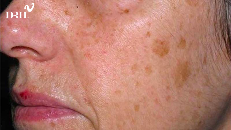 Đồi mồi là một dạng tổn thương thường gặp ở người ngoài 40 tuổi