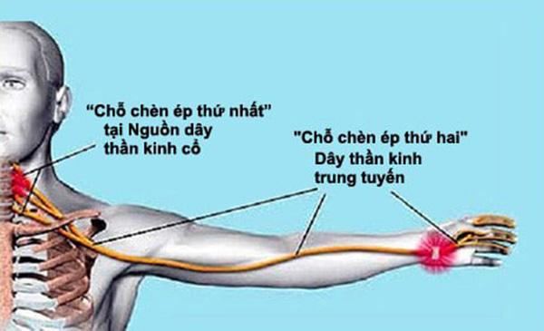 Đau mỏi cổ vai gáy, tê bì chân tay làm sao để hết? - 2