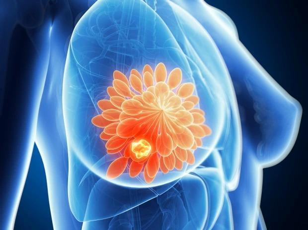 Kích thước vòng một và những lầm tưởng phổ biến về ung thư vú - 2