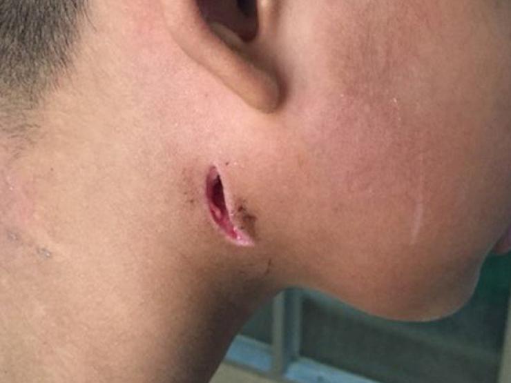 Sức khỏe đời sống - Bệnh Whitmore không lây từ người sang người nhưng tỉ lệ tử vong cao