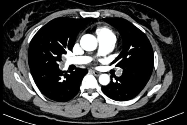Hỉnh ảnh kiểm tra cho thấy người bệnh bị thuyên tắc động mạch phổi cả 2 bên