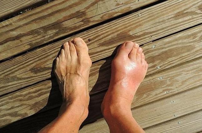 Những dấu hiệu khác thường trên bàn chân cho thấy sức khỏe của bạn đang 