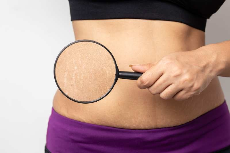 Lấy lại làn da mịn màng với bí kíp mờ rạn da sau sinh cực đơn giản - 1