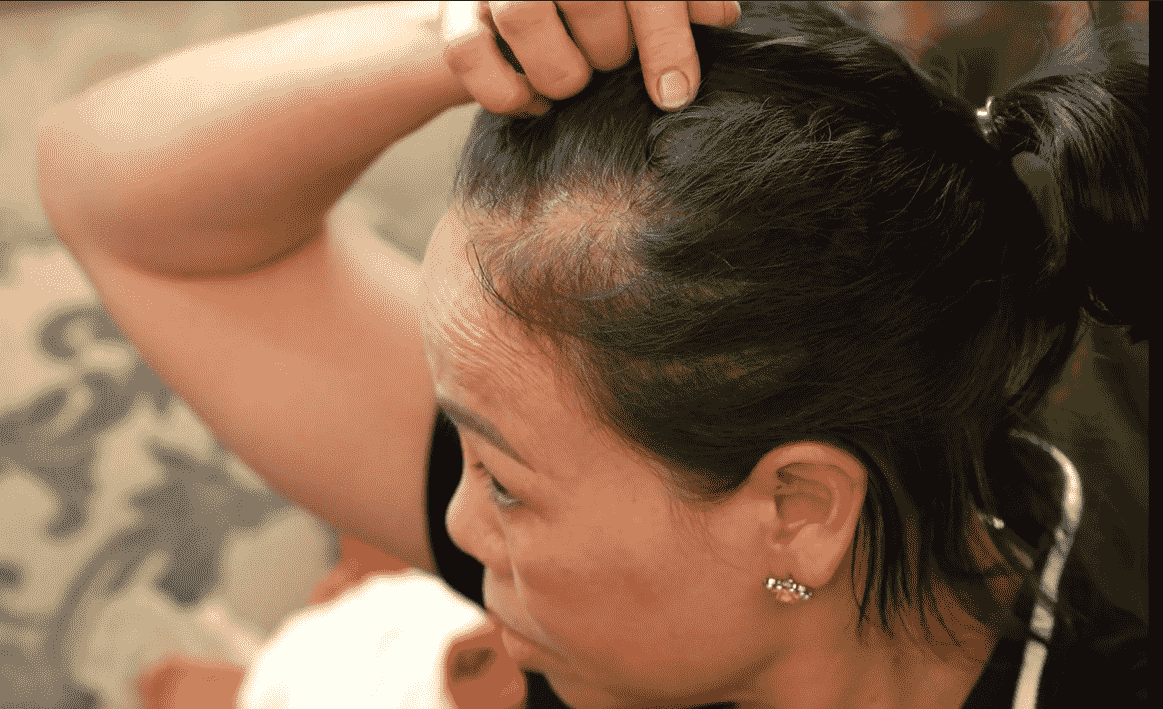 Tóc cô Nga rụng đến thưa cả tóc mái
