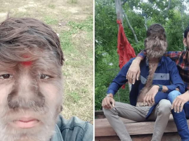 Bạn trẻ - Cuộc sống - Chàng trai "người sói" với khát khao bước qua định kiến xã hội