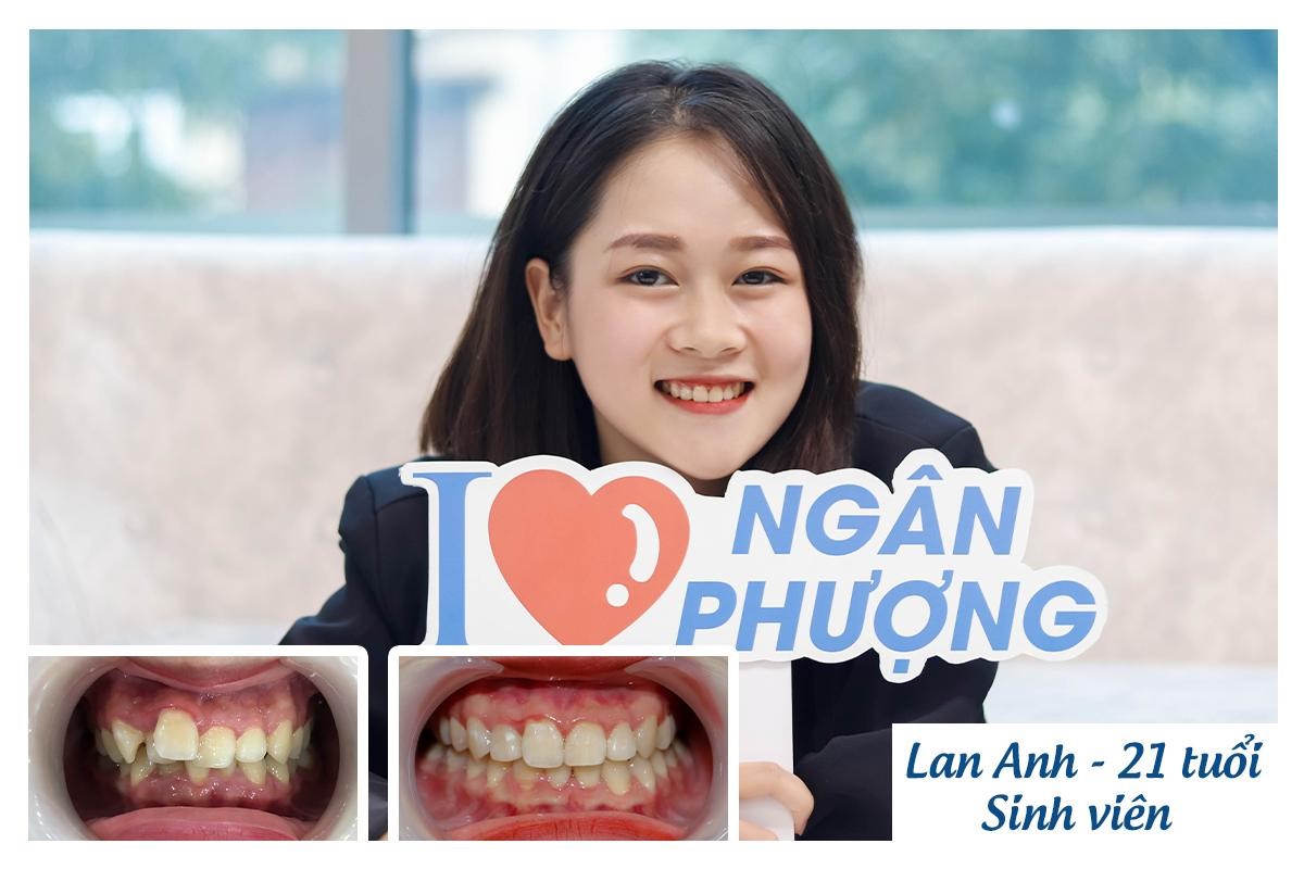 Lan Anh niềng răng trong 1,5 năm tại Nha khoa Ngân Phượng