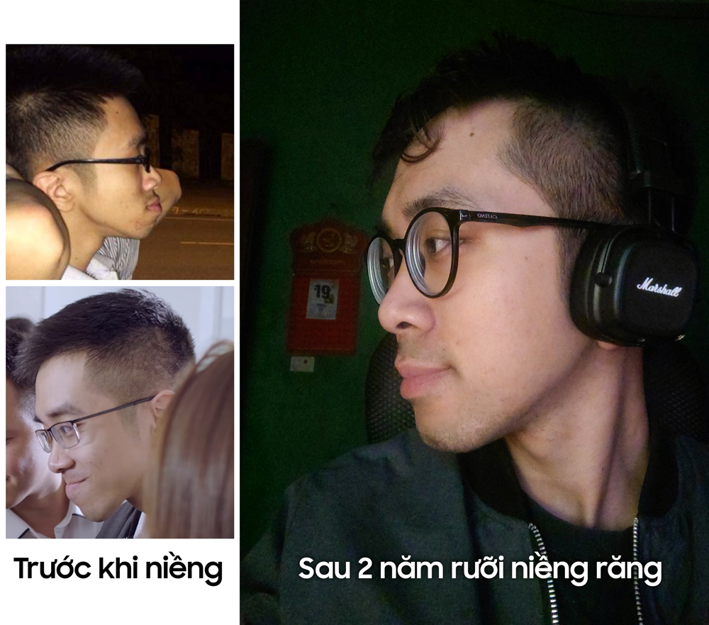 Duy Hoàng trước và sau khi niềng răng được 2,5 năm