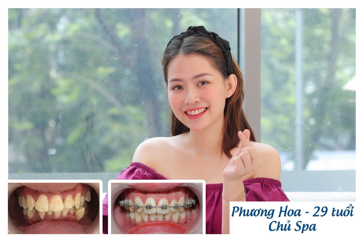 Phương Hoa hài lòng với thành quả niềng răng của mình