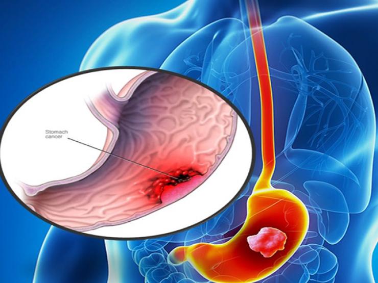 6 dấu hiệu cảnh báo ung thư dạ dày